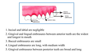1. Incisal and labial are negligible
2. Gingival and lingual embrasures between anterior teeth are the widest
and longest in mouth
3. Buccal embrasures are small
4. Lingual embrasures are long, with medium width
5. Gingival embrasures between posterior teeth are broad and long
 