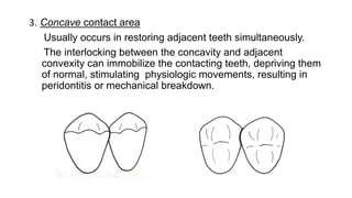 3. Concave contact area
Usually occurs in restoring adjacent teeth simultaneously.
The interlocking between the concavity and adjacent
convexity can immobilize the contacting teeth, depriving them
of normal, stimulating physiologic movements, resulting in
peridontitis or mechanical breakdown.
 