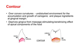 Contour
• Over convex curvatures - undisturbed environment for the
accumulation and growth of cariogenic and plaque ingredients
at gingival margin.
• Deprives gingiva from massage-stimulating-keratinizing effect
of apical components of the food
 