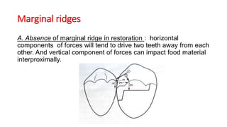 Marginal ridges
A. Absence of marginal ridge in restoration : horizontal
components of forces will tend to drive two teeth away from each
other. And vertical component of forces can impact food material
interproximally.
 