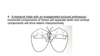B. A marginal ridge with an exaggerated occlusal embrasure :
horizontal components of forces will separate teeth and vertical
components will drive debris interproximally
 
