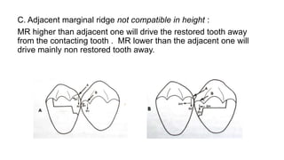 C. Adjacent marginal ridge not compatible in height :
MR higher than adjacent one will drive the restored tooth away
from the contacting tooth . MR lower than the adjacent one will
drive mainly non restored tooth away.
 