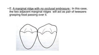 • E. A marginal ridge with no occlusal embrasure : In this case,
the two adjacent marginal ridges will act as pair of tweezers
grasping food passing over it.
 