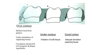 Over contour
Deflects food from
gingiva
Under stimulation of
supporting tissues
Circulation and growth
of Cariogenic & plaque
ingredients
Under contour
Irritation of soft tissue
Correct contour
Adequate stimulation
supporting tissues
 