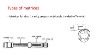 Types of matrices
• Matrices for class 1 cavity preparation(double banded tofflemire )
 