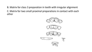 B. Matrix for class 3 preparation in teeth with irregular alignment
C. Matrix for two small proximal preparations in contact with each
other
 