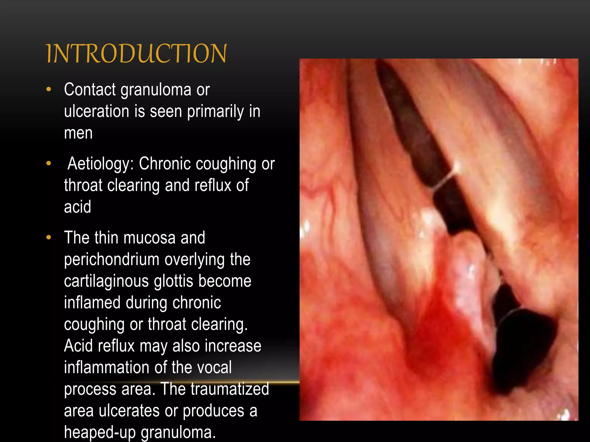 Contact ulcer | PPTX, image size:2048x1536