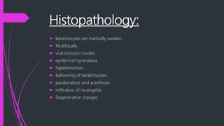 Histopathology:
 keratinocytes are markedly swollen.
 Multifocally,
 viral inclusion bodies.
 epidermal hyperplasia
 hyperkeratosis.
 Ballooning of keratinocytes.
 parakeratosis and acanthosis
 infiltration of neutrophils
 Degenerative changes
 