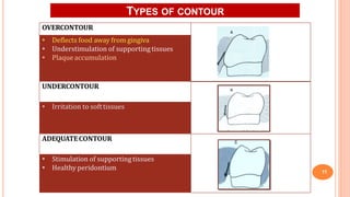 TYPES OF CONTOUR
11
OVERCONTOUR
• Deflects food away from gingiva
• Understimulation of supportingtissues
• Plaque accumulation
UNDERCONTOUR
• Irritation to softtissues
ADEQUATECONTOUR
• Stimulation of supportingtissues
• Healthy peridontium
 