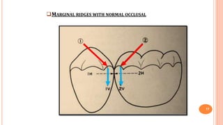 MARGINAL RIDGES WITH NORMAL OCCLUSAL
17
 