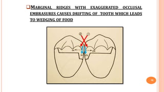 MARGINAL RIDGES WITH EXAGGERATED OCCLUSAL
EMBRASURES CAUSES DRIFTING OF TOOTH WHICH LEADS
TO WEDGING OF FOOD
18
 