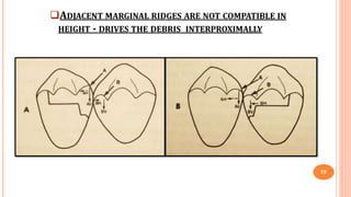 ADJACENT MARGINAL RIDGES ARE NOT COMPATIBLE IN
HEIGHT - DRIVES THE DEBRIS INTERPROXIMALLY
19
 