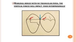 MARGINAL RIDGES WITH NO TRIANGULAR FOSSA, THE
VERTICAL FORCES WILL IMPACT FOOD INTERPROXIMALLY
20
 