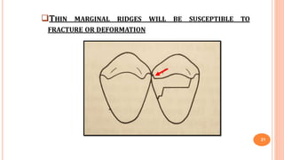 THIN MARGINAL RIDGES WILL BE SUSCEPTIBLE TO
FRACTURE OR DEFORMATION
21
 