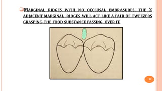 MARGINAL RIDGES WITH NO OCCLUSAL EMBRASURES, THE 2
ADJACENT MARGINAL RIDGES WILL ACT LIKE A PAIR OF TWEEZERS
GRASPING THE FOOD SUBSTANCE PASSING OVER IT.
22
 