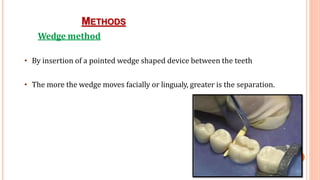 METHODS
27
Wedge method
• By insertion of a pointed wedge shaped device between the teeth
• The more the wedge moves facially or lingualy, greater is the separation.
 