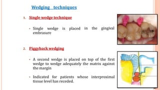 41
Wedging techniques
in the gingival
1. Single wedge technique
• Single wedge is placed
embrasure
2. Piggyback wedging
• A second wedge is placed on top of the first
wedge to wedge adequately the matrix against
the margin
• Indicated for patients whose interproximal
tissue level has receded.
31
 