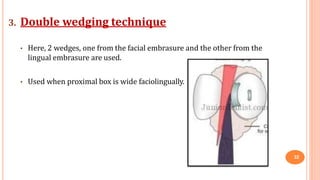 3. Double wedging technique
• Here, 2 wedges, one from the facial embrasure and the other from the
lingual embrasure are used.
• Used when proximal box is wide faciolingually.
32
 