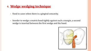 4. Wedge wedging technique
• Used in cases when there is a gingival concavity.
• Inorder to wedge a matrix band tightly against such a margin, a second
wedge is inserted between the first wedge and the band.
33
 
