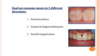 Food we consume moves in 3 different
directions:
1. Occlusal surfaces
2. Contact & Gingival embrasures
3. Facial & Lingual sulcus
5
 