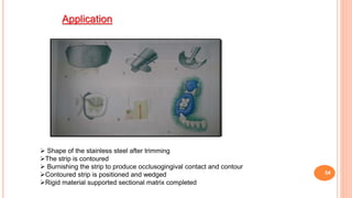 54
 Shape of the stainless steel after trimming
The strip is contoured
 Burnishing the strip to produce occlusogingival contact and contour
Contoured strip is positioned and wedged
Rigid material supported sectional matrix completed
Application
 