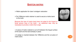 BARTON MATRIX
55
 Matrix application for class I amalgam restoration
The Tofflemire matrix retainer is used to secure a matrix band
to the tooth.
Because this type of matrix band does not adapt to the lingual or
facial groove area of the tooth , an additional step may be
necessary to provide a matrix that is rigid.
 A piece of matrix material is cut to fit between the lingual surface
of the tooth and the band already in place.
A wedge is inserted between the Tofflemire and the cut piece of
matric band.
 