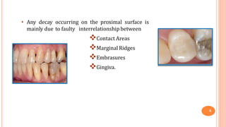 • Any decay occurring on the proximal surface is
mainly due to faulty interrelationship between
Contact Areas
Marginal Ridges
Embrasures
Gingiva.
6
 