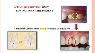 TIME OF ERUPTION: ONLY
CONTACT POINT ARE PRESENT
• Proximal Contact Point Proximal Contact Area
7
 