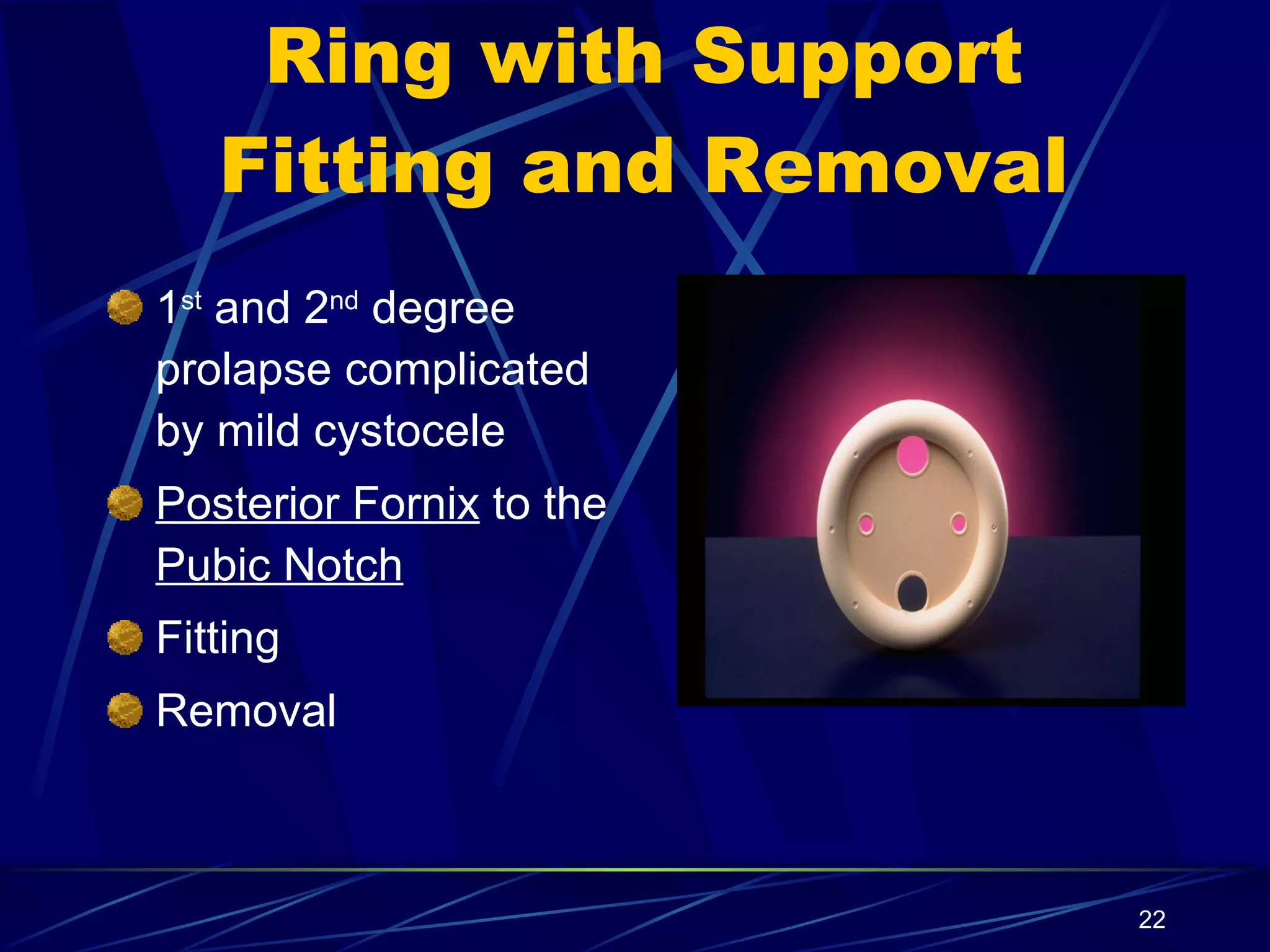 Ring with Support Fitting and Removal 1 st  and 2 nd  degree prolapse complicated by mild cystocele Posterior Fornix  to the  Pubic Notch Fitting Removal 