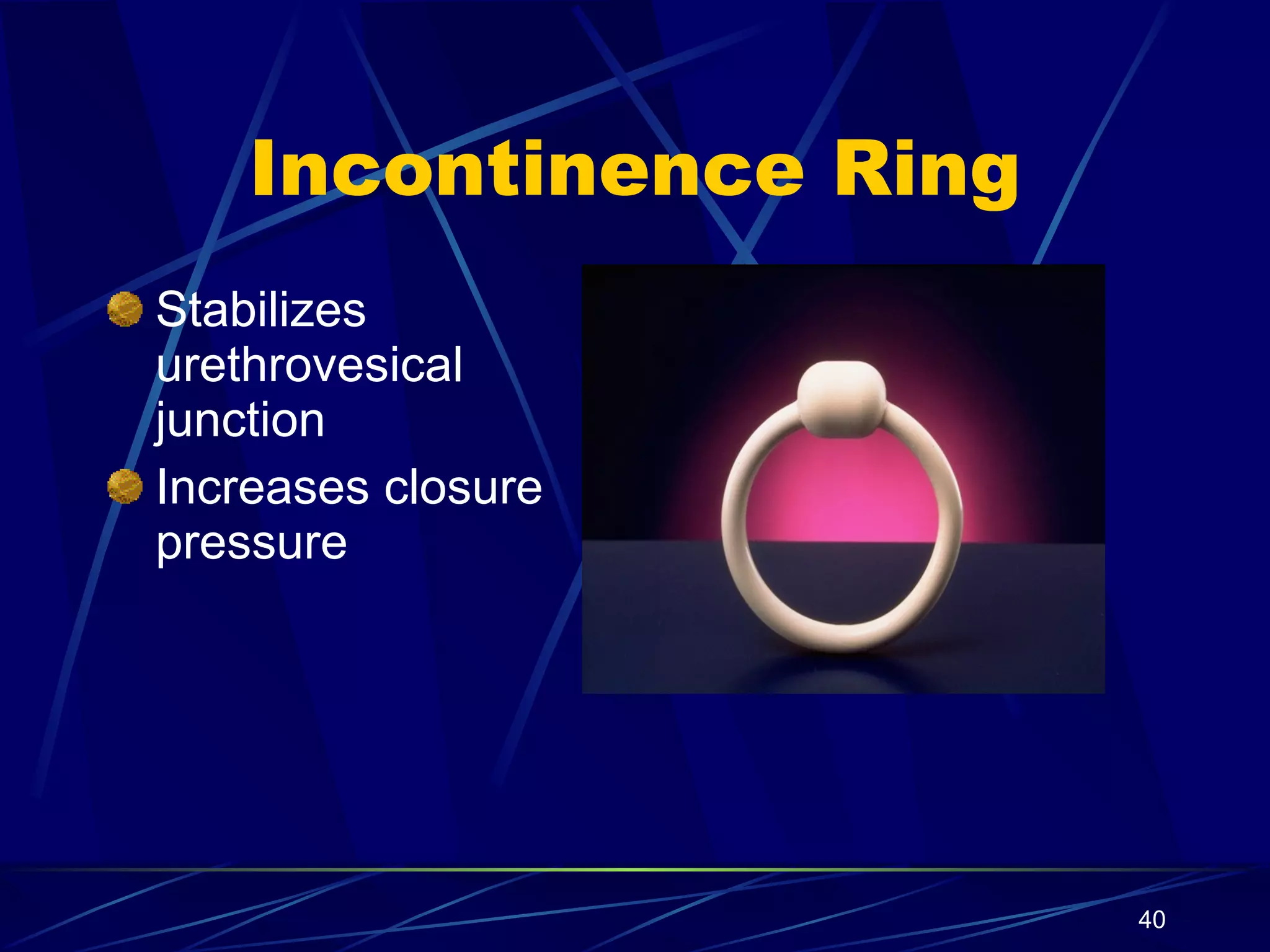 Incontinence Ring Stabilizes urethrovesical junction Increases closure pressure 