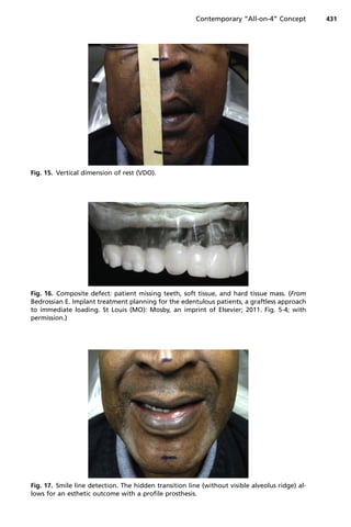 Fig. 15. Vertical dimension of rest (VDO).
Fig. 16. Composite defect: patient missing teeth, soft tissue, and hard tissue mass. (From
Bedrossian E. Implant treatment planning for the edentulous patients, a graftless approach
to immediate loading. St Louis (MO): Mosby, an imprint of Elsevier; 2011. Fig. 5-4; with
permission.)
Fig. 17. Smile line detection. The hidden transition line (without visible alveolus ridge) al-
lows for an esthetic outcome with a profile prosthesis.
Contemporary “All-on-4” Concept 431
 