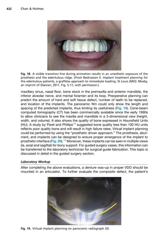maxillary sinus, nasal floor, bone stock in the premaxilla and anterior mandible, the
inferior alveolar nerve, and mental foramen and its loop. Preoperative planning can
predict the amount of hard and soft tissue defect, number of teeth to be replaced,
and location of the implants. The panoramic film could only show the length and
spacing of the predicted implants, thus limiting its usefulness (Fig. 19). Cone-beam
computed tomography (CT) has been commercially available since the early 1990s
to allow clinicians to see the maxilla and mandible in a 3-dimensional view (height,
width, and volume). It also shows the quality of bone expressed in Hounsfield Units
(HU). A study by Parel and Phillips18
suggested bone quality less than 100 HU units
reflects poor quality bone and will result in high failure rates. Virtual implant planning
could be performed by using the “prosthetic driven approach.” The prosthesis, abut-
ment, and implants can be designed to ensure proper emergence of the implant to
prosthetic interface (Fig. 20).19
Moreover, these implants can be seen in multiple views
(ie, axial and sagittal) for bony support. For guided surgery cases, this information can
be transferred to the laboratory technician for surgical guide fabrication. This topic is
discussed in detail in the guided surgery section.
Laboratory Workup
After completing the above evaluations, a denture wax-up in proper VDO should be
mounted in an articulator. To further evaluate the composite defect, the patient’s
Fig. 18. A visible transition line during animation results in an unesthetic exposure of the
prosthesis and the edentulous ridge. (From Bedrossian E. Implant treatment planning for
the edentulous patients, a graftless approach to immediate loading. St Louis (MO): Mosby,
an imprint of Elsevier; 2011. Fig. 5-11; with permission.)
Fig. 19. Virtual implant planning on panoramic radiograph 2D.
Chan  Holmes
432
 