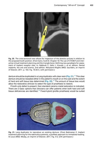 denture should be duplicated in a Lang duplicator with clear resin (Fig. 21).16
This clear
denture should be reseated either in the patient’s mouth or on the cast and the extent
of hard and soft tissue loss determined (Fig. 22).16
The amount of tissue loss would
allow the restorative clinician to select the type of prosthesis to restore.
If tooth-only defect is present, then standard ceramo-metal restoration is indicated.
There are 2 basic options that clinicians can offer patients when both hard and soft
tissue deficiencies are identified.16
Fixed-hybrid (profile prosthesis) would be suited
Fig. 20. The cross-sectional view allows for inspection of the alveolus process in relation to
the proposed tooth position. (From Ganz, Scott D. Chapter 10: The use of CT/CBCT and inter-
active virtual treatment planning and the triangle bone: Defining new paradigms for assess-
ment of implant receptor sites. In: Babbush C, Hahn J, Krauser J, et al, editors. Dental
implants, the arts and science, 2nd edition. Maryland Heights (MO): Saunders, an imprint
of Elsevier; 2011. p. 163. Fig. 10-26 C; with permission.)
Fig. 21. Lang duplicator to reproduce an existing denture. (From Bedrossian E. Implant
treatment planning for the edentulous patients, a graftless approach to immediate loading.
St Louis (MO): Mosby, an imprint of Elsevier; 2011. Fig. 5-5; with permission.)
Contemporary “All-on-4” Concept 433
 
