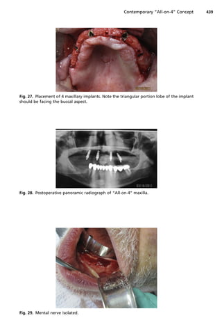 Fig. 28. Postoperative panoramic radiograph of “All-on-4” maxilla.
Fig. 29. Mental nerve isolated.
Fig. 27. Placement of 4 maxillary implants. Note the triangular portion lobe of the implant
should be facing the buccal aspect.
Contemporary “All-on-4” Concept 439
 