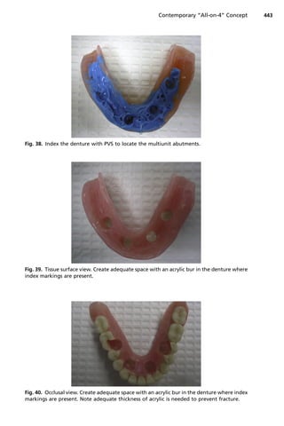 Fig. 38. Index the denture with PVS to locate the multiunit abutments.
Fig. 39. Tissue surface view. Create adequate space with an acrylic bur in the denture where
index markings are present.
Fig. 40. Occlusal view. Create adequate space with an acrylic bur in the denture where index
markings are present. Note adequate thickness of acrylic is needed to prevent fracture.
Contemporary “All-on-4” Concept 443
 