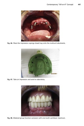 Fig. 46. Place the impression copings closed tray onto the multiunit abutments.
Fig. 47. Take an impression and send to laboratory.
Fig. 48. Bilateral group function occlusion with one-tooth cantilever maximum.
Contemporary “All-on-4” Concept 447
 