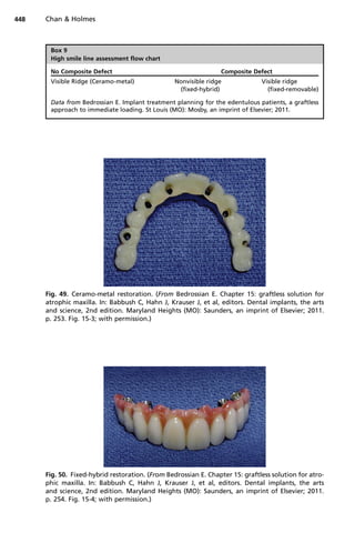 Box 9
High smile line assessment flow chart
No Composite Defect Composite Defect
Visible Ridge (Ceramo-metal) Nonvisible ridge
(fixed-hybrid)
Visible ridge
(fixed-removable)
Data from Bedrossian E. Implant treatment planning for the edentulous patients, a graftless
approach to immediate loading. St Louis (MO): Mosby, an imprint of Elsevier; 2011.
Fig. 49. Ceramo-metal restoration. (From Bedrossian E. Chapter 15: graftless solution for
atrophic maxilla. In: Babbush C, Hahn J, Krauser J, et al, editors. Dental implants, the arts
and science, 2nd edition. Maryland Heights (MO): Saunders, an imprint of Elsevier; 2011.
p. 253. Fig. 15-3; with permission.)
Fig. 50. Fixed-hybrid restoration. (From Bedrossian E. Chapter 15: graftless solution for atro-
phic maxilla. In: Babbush C, Hahn J, Krauser J, et al, editors. Dental implants, the arts
and science, 2nd edition. Maryland Heights (MO): Saunders, an imprint of Elsevier; 2011.
p. 254. Fig. 15-4; with permission.)
Chan  Holmes
448
 