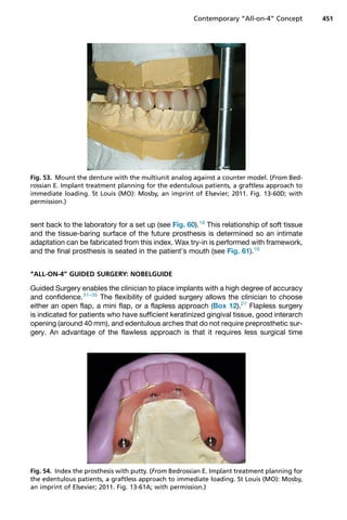 sent back to the laboratory for a set up (see Fig. 60).16
This relationship of soft tissue
and the tissue-baring surface of the future prosthesis is determined so an intimate
adaptation can be fabricated from this index. Wax try-in is performed with framework,
and the final prosthesis is seated in the patient’s mouth (see Fig. 61).16
“ALL-ON-4” GUIDED SURGERY: NOBELGUIDE
Guided Surgery enables the clinician to place implants with a high degree of accuracy
and confidence.31–35
The flexibility of guided surgery allows the clinician to choose
either an open flap, a mini flap, or a flapless approach (Box 12).27
Flapless surgery
is indicated for patients who have sufficient keratinized gingival tissue, good interarch
opening (around 40 mm), and edentulous arches that do not require preprosthetic sur-
gery. An advantage of the flawless approach is that it requires less surgical time
Fig. 53. Mount the denture with the multiunit analog against a counter model. (From Bed-
rossian E. Implant treatment planning for the edentulous patients, a graftless approach to
immediate loading. St Louis (MO): Mosby, an imprint of Elsevier; 2011. Fig. 13-60D; with
permission.)
Fig. 54. Index the prosthesis with putty. (From Bedrossian E. Implant treatment planning for
the edentulous patients, a graftless approach to immediate loading. St Louis (MO): Mosby,
an imprint of Elsevier; 2011. Fig. 13-61A; with permission.)
Contemporary “All-on-4” Concept 451
 