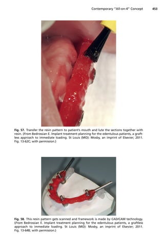 Fig. 57. Transfer the resin pattern to patient’s mouth and lute the sections together with
resin. (From Bedrossian E. Implant treatment planning for the edentulous patients, a graft-
less approach to immediate loading. St Louis (MO): Mosby, an imprint of Elsevier; 2011.
Fig. 13-62C; with permission.)
Fig. 58. This resin pattern gets scanned and framework is made by CAD/CAM technology.
(From Bedrossian E. Implant treatment planning for the edentulous patients, a graftless
approach to immediate loading. St Louis (MO): Mosby, an imprint of Elsevier; 2011.
Fig. 13-64B; with permission.)
Contemporary “All-on-4” Concept 453
 