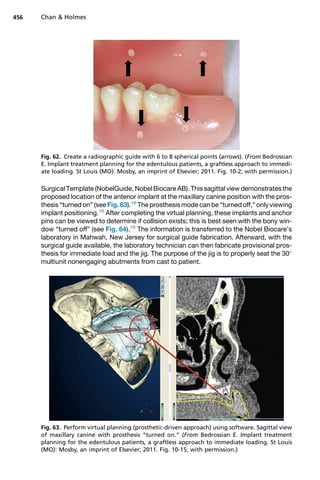 Surgical Template (NobelGuide, Nobel Biocare AB). This sagittal view demonstrates the
proposed location of the anterior implant at the maxillary canine position with the pros-
thesis “turned on” (see Fig. 63).16
The prosthesis mode can be “turned off,” only viewing
implant positioning.16
After completing the virtual planning, these implants and anchor
pins can be viewed to determine if collision exists; this is best seen with the bony win-
dow “turned off” (see Fig. 64).16
The information is transferred to the Nobel Biocare’s
laboratory in Mahwah, New Jersey for surgical guide fabrication. Afterward, with the
surgical guide available, the laboratory technician can then fabricate provisional pros-
thesis for immediate load and the jig. The purpose of the jig is to properly seat the 30
multiunit nonengaging abutments from cast to patient.
Fig. 62. Create a radiographic guide with 6 to 8 spherical points (arrows). (From Bedrossian
E. Implant treatment planning for the edentulous patients, a graftless approach to immedi-
ate loading. St Louis (MO): Mosby, an imprint of Elsevier; 2011. Fig. 10-2; with permission.)
Fig. 63. Perform virtual planning (prosthetic-driven approach) using software. Sagittal view
of maxillary canine with prosthesis “turned on.” (From Bedrossian E. Implant treatment
planning for the edentulous patients, a graftless approach to immediate loading. St Louis
(MO): Mosby, an imprint of Elsevier; 2011. Fig. 10-15; with permission.)
Chan  Holmes
456
 