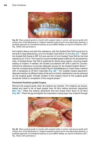 first implant sleeve and start the osteotomy with the Guided Start Drill (round bur) to
the built-in stop followed by a 2.0-mm Guided Twist Drill to 13 mm (Fig. 67).16
Switch
the Guided Drill Guide to (RP 3.2) and use the 3.2-mm Guided Twist Drill for the final
osteotomy to 13 mm. The maximum recommended speed is 800 rpm for all osteotomy
sites. A Guided Screw Tap Drill is preferred for dense bone regions, ensuring proper
seating of implant. If needed, the Guided Counterbore RP Drill is used for counter-
sinking the osteotomy to provide adequate access for the Guided Implant Mount.16
Use the corresponding Guided Implant Mount NobelReplace to insert these implants
with a handpiece at 45 Ncm maximally (Fig. 68).16
For multiple implant placement,
alternate insertion at different sides of the arch so further stabilization can be achieved
on the surgical guide. Intimate contact of the implant mount to the surgical guide
should be noted on completion of the surgical phase.16
Provisional Prosthesis-guided Surgery
Remove the surgical guide when all implants are inserted. The implants are torque-
tested and need to be at least greater than 35 Ncm before abutment placement
(Box 16).16
Place the anterior abutments first and torque them down to 35 Ncm
(Fig. 69).16
Place the jig and tighten the impression coping open tray multiunit through
Fig. 65. Place surgical guide in mouth with surgical index in centric and secure guide with
anchor pins. (From Bedrossian E. Implant treatment planning for the edentulous patients, a
graftless approach to immediate loading. St Louis (MO): Mosby, an imprint of Elsevier; 2011.
Fig. 10-60; with permission.)
Fig. 66. Place surgical guide in mouth with surgical index in centric and secure guide with
anchor pins. (From Bedrossian E. Implant treatment planning for the edentulous patients, a
graftless approach to immediate loading. St Louis (MO): Mosby, an imprint of Elsevier; 2011.
Fig. 10-62; with permission.)
Chan  Holmes
458
 