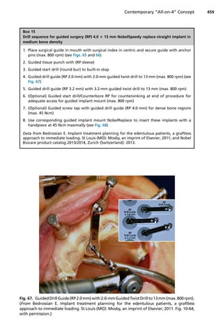 Fig. 67. Guided DrillGuide(RP2.0mm) with2.0-mmGuidedTwistDrillto13mm(max.800 rpm).
(From Bedrossian E. Implant treatment planning for the edentulous patients, a graftless
approach to immediate loading. St Louis (MO): Mosby, an imprint of Elsevier; 2011. Fig. 10-64;
with permission.)
Box 15
Drill sequence for guided surgery (RP) 4.0 3 13 mm NobelSpeedy replace straight implant in
medium bone density
1. Place surgical guide in mouth with surgical index in centric and secure guide with anchor
pins (max. 800 rpm) (see Figs. 65 and 66)
2. Guided tissue punch with (RP sleeve)
3. Guided start drill (round bur) to built-in stop
4. Guided drill guide (RP 2.0 mm) with 2.0-mm guided twist drill to 13 mm (max. 800 rpm) (see
Fig. 67)
5. Guided drill guide (RP 3.2 mm) with 3.2-mm guided twist drill to 13 mm (max. 800 rpm)
6. (Optional) Guided start drill/Counterbore RP for countersinking at end of procedure for
adequate access for guided implant mount (max. 800 rpm)
7. (Optional) Guided screw tap with guided drill guide (RP 4.0 mm) for dense bone regions
(max. 45 Ncm)
8. Use corresponding guided implant mount NobelReplace to insert these implants with a
handpiece at 45 Ncm maximally (see Fig. 68)
Data from Bedrossian E. Implant treatment planning for the edentulous patients, a graftless
approach to immediate loading. St Louis (MO): Mosby, an imprint of Elsevier; 2011; and Nobel
Biocare product catalog 2013/2014, Zurich (Switzerland): 2013.
Contemporary “All-on-4” Concept 459
 