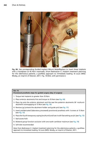 Fig. 68. Use corresponding Guided Implant Mount NobelReplace to insert these implants
with a handpiece at 45 Ncm maximally. (From Bedrossian E. Implant treatment planning
for the edentulous patients, a graftless approach to immediate loading. St Louis (MO):
Mosby, an imprint of Elsevier; 2011. Fig. 10-65A; with permission.)
Box 16
Provisional prosthetic steps for guided surgery (day of surgery)
1. Torque test implants to greater than 35 Ncm
2. Place anterior abutments first and torque to 35 Ncm (see Fig. 69)
3. Place Jig onto the anterior abutment and the seat the posterior abutments 30
multiunit
abutment nonengaging at 15 Ncm (see Fig. 70)
4. Remove jig (untwist the abutment holder and guide pin) (see Fig. 71)
5. Insert prefabricated (laboratory processed) provisional prosthesis with 3 screws at 15 Ncm
(see Fig. 72)
6. Place the fourth temporary coping (multiunit) and lute it with fast setting acrylic (see Fig. 73)
7. Seal access hole
8. Bilateral group function occlusion with one tooth cantilever maximum (see Fig. 74)
9. Soft diet recommended
Data from Bedrossian E. Implant treatment planning for the edentulous patients, a graftless
approach to immediate loading. St Louis (MO): Mosby, an imprint of Elsevier; 2011.
Chan  Holmes
460
 