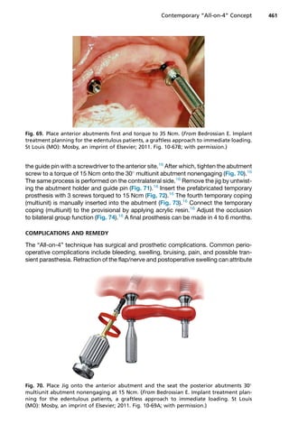 the guide pin with a screwdriver to the anterior site.16
After which, tighten the abutment
screw to a torque of 15 Ncm onto the 30
multiunit abutment nonengaging (Fig. 70).16
The same process is performed on the contralateral side.16
Remove the jig by untwist-
ing the abutment holder and guide pin (Fig. 71).16
Insert the prefabricated temporary
prosthesis with 3 screws torqued to 15 Ncm (Fig. 72).16
The fourth temporary coping
(multiunit) is manually inserted into the abutment (Fig. 73).16
Connect the temporary
coping (multiunit) to the provisional by applying acrylic resin.16
Adjust the occlusion
to bilateral group function (Fig. 74).16
A final prosthesis can be made in 4 to 6 months.
COMPLICATIONS AND REMEDY
The “All-on-4” technique has surgical and prosthetic complications. Common perio-
operative complications include bleeding, swelling, bruising, pain, and possible tran-
sient parasthesia. Retraction of the flap/nerve and postoperative swelling can attribute
Fig. 69. Place anterior abutments first and torque to 35 Ncm. (From Bedrossian E. Implant
treatment planning for the edentulous patients, a graftless approach to immediate loading.
St Louis (MO): Mosby, an imprint of Elsevier; 2011. Fig. 10-67B; with permission.)
Fig. 70. Place Jig onto the anterior abutment and the seat the posterior abutments 30
multiunit abutment nonengaging at 15 Ncm. (From Bedrossian E. Implant treatment plan-
ning for the edentulous patients, a graftless approach to immediate loading. St Louis
(MO): Mosby, an imprint of Elsevier; 2011. Fig. 10-69A; with permission.)
Contemporary “All-on-4” Concept 461
 