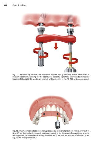 Fig. 72. Insert prefabricated (laboratory processed) provisional prosthesis with 3 screws at 15
Ncm. (From Bedrossian E. Implant treatment planning for the edentulous patients, a graft-
less approach to immediate loading. St Louis (MO): Mosby, an imprint of Elsevier; 2011.
Fig. 10-71; with permission.)
Fig. 71. Remove Jig (untwist the abutment holder and guide pin). (From Bedrossian E.
Implant treatment planning for the edentulous patients, a graftless approach to immediate
loading. St Louis (MO): Mosby, an imprint of Elsevier; 2011. Fig. 10-70B; with permission.)
Chan  Holmes
462
 