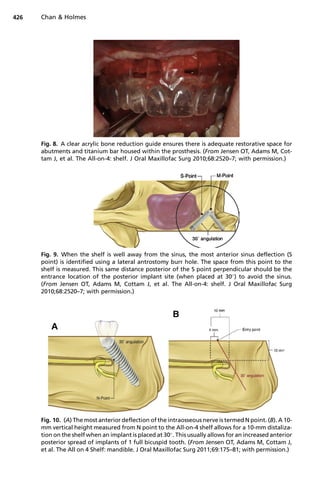 Fig. 8. A clear acrylic bone reduction guide ensures there is adequate restorative space for
abutments and titanium bar housed within the prosthesis. (From Jensen OT, Adams M, Cot-
tam J, et al. The All-on-4: shelf. J Oral Maxillofac Surg 2010;68:2520–7; with permission.)
Fig. 9. When the shelf is well away from the sinus, the most anterior sinus deflection (S
point) is identified using a lateral antrostomy burr hole. The space from this point to the
shelf is measured. This same distance posterior of the S point perpendicular should be the
entrance location of the posterior implant site (when placed at 30
) to avoid the sinus.
(From Jensen OT, Adams M, Cottam J, et al. The All-on-4: shelf. J Oral Maxillofac Surg
2010;68:2520–7; with permission.)
Fig. 10. (A) The most anterior deflection of the intraosseous nerve is termed N point. (B). A 10-
mm vertical height measured from N point to the All-on-4 shelf allows for a 10-mm distaliza-
tion on the shelf when an implant is placed at 30
. This usually allows for an increased anterior
posterior spread of implants of 1 full bicuspid tooth. (From Jensen OT, Adams M, Cottam J,
et al. The All on 4 Shelf: mandible. J Oral Maxillofac Surg 2011;69:175–81; with permission.)
Chan  Holmes
426
 