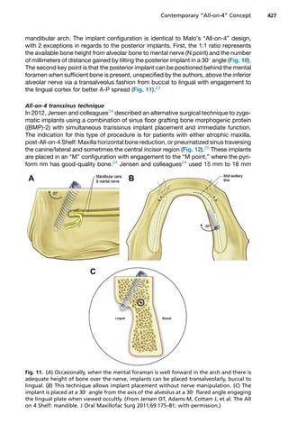 mandibular arch. The implant configuration is identical to Malo’s “All-on-4” design,
with 2 exceptions in regards to the posterior implants. First, the 1:1 ratio represents
the available bone height from alveolar bone to mental nerve (N point) and the number
of millimeters of distance gained by tilting the posterior implant in a 30
angle (Fig. 10).
The second key point is that the posterior implant can be positioned behind the mental
foramen when sufficient bone is present, unspecified by the authors, above the inferior
alveolar nerve via a transalveolus fashion from buccal to lingual with engagement to
the lingual cortex for better A-P spread (Fig. 11).23
All-on-4 transsinus technique
In 2012, Jensen and colleagues24
described an alternative surgical technique to zygo-
matic implants using a combination of sinus floor grafting bone morphogenic protein
((BMP)-2) with simultaneous transsinus implant placement and immediate function.
The indication for this type of procedure is for patients with either atrophic maxilla,
post-All-on-4 Shelf: Maxilla horizontal bone reduction, or pneumatized sinus traversing
the canine/lateral and sometimes the central incisor region (Fig. 12).25
These implants
are placed in an “M” configuration with engagement to the “M point,” where the pyri-
form rim has good-quality bone.24
Jensen and colleagues24
used 15 mm to 18 mm
Fig. 11. (A) Occasionally, when the mental foraman is well forward in the arch and there is
adequate height of bone over the nerve, implants can be placed transalveolarly, buccal to
lingual. (B) This technique allows implant placement without nerve manipulation. (C) The
implant is placed at a 30
angle from the axis of the alveolus at a 30
flared angle engaging
the lingual plate when viewed occultly. (From Jensen OT, Adams M, Cottam J, et al. The All
on 4 Shelf: mandible. J Oral Maxillofac Surg 2011;69:175–81; with permission.)
Contemporary “All-on-4” Concept 427
 