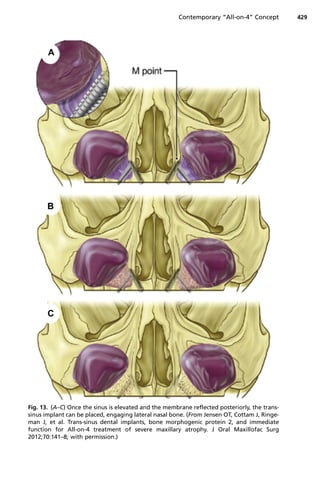 Fig. 13. (A–C) Once the sinus is elevated and the membrane reflected posteriorly, the trans-
sinus implant can be placed, engaging lateral nasal bone. (From Jensen OT, Cottam J, Ringe-
man J, et al. Trans-sinus dental implants, bone morphogenic protein 2, and immediate
function for All-on-4 treatment of severe maxillary atrophy. J Oral Maxillofac Surg
2012;70:141–8; with permission.)
Contemporary “All-on-4” Concept 429
 