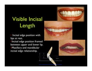 Visible Incisal
Length
Incisal edge position with
lips at rest.
Incisal edge position framed
between upper and lower lip.
Maxillary and mandibular
incisal edge relationship.

http://c1-preview.prosites.com/10426/wy/images/Embrasures.gifweb.gif

 