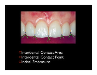 Interdental Contact Area
Interdental Contact Point
Incisal Embrasure

 